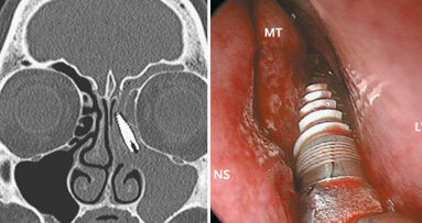 Scoperto un impianto nella cavità nasale di un paziente
