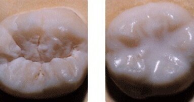 Sealants dentaires: plus seulement pour les enfants