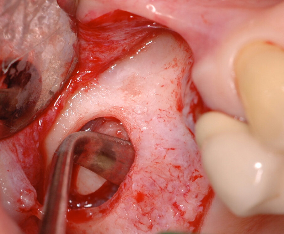 Figg. 6, 7_Fasi dello scollamento manuale della membrana Schneideriana.