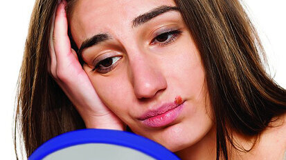 Forward Science licenses cold sore drug from EPI Health Forward Science licenses cold sore drug from EPI Health