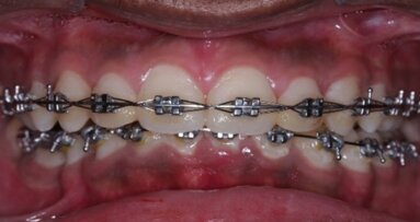 Innovative coating on dental appliances prevents bacterial growth