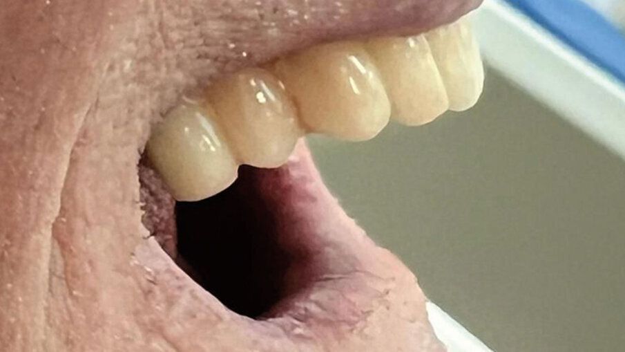 Fig. 14 - Inserimento provvisori - vista laterale.