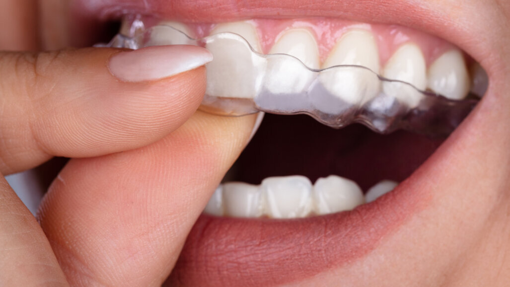 Launch of Aligner Dental Academy announced