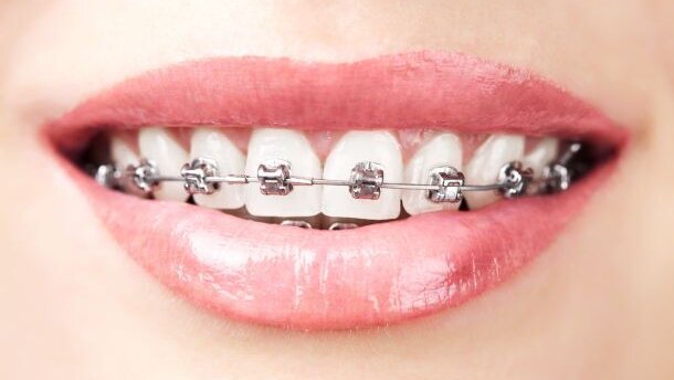Orthodontisten onder vuur: tarieven gedaald, omzet stijgt