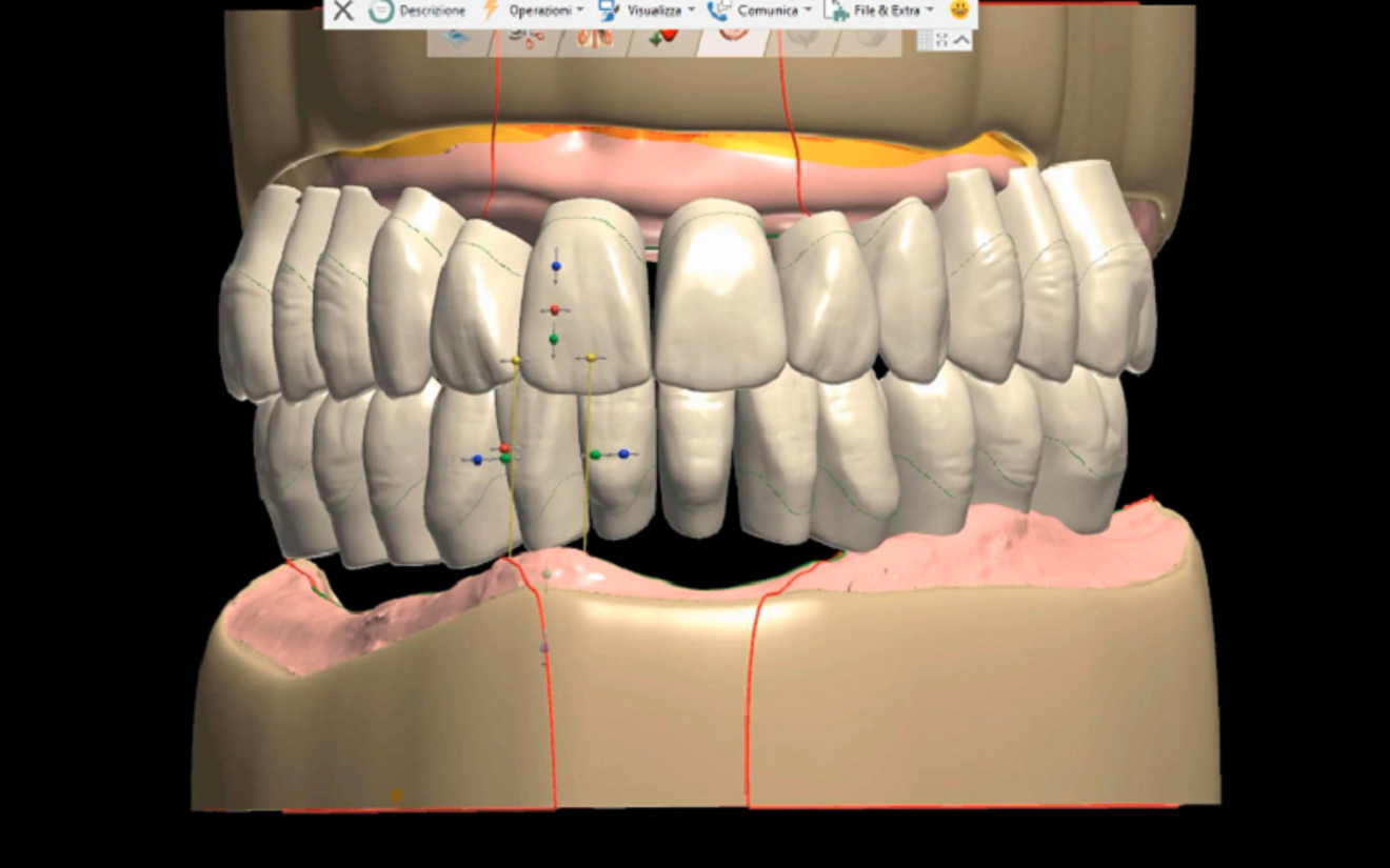 Fig. 6: Maxillary and mandibular prostheses designed with Ivotion libraries.