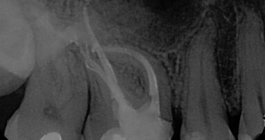 DENTSPLY Tulsa announces winners of GuttaCore University Challenge