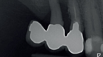 Il Biopad® come coadiuvante emostatico nei processi di guarigione dell’alveolo post-estrattivo