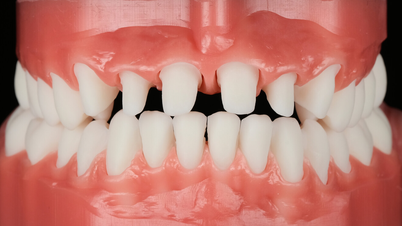 Fig. 7: Alveolar models printed in gingival and tooth-coloured materials.