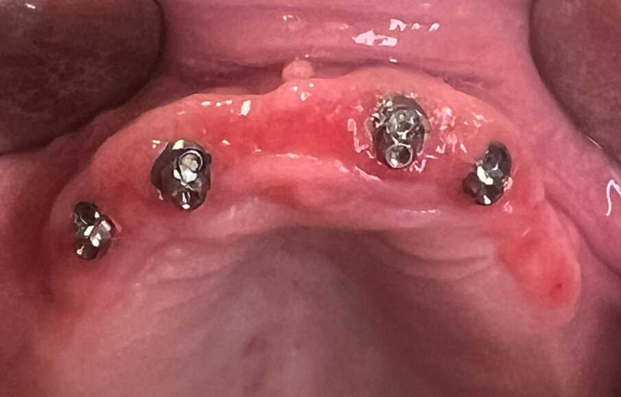 Fig. 3_Dopo la rimozione della Toronto superiore si evidenziano aree di infiammazione cronica dei tessuti del tragitto transmucoso.