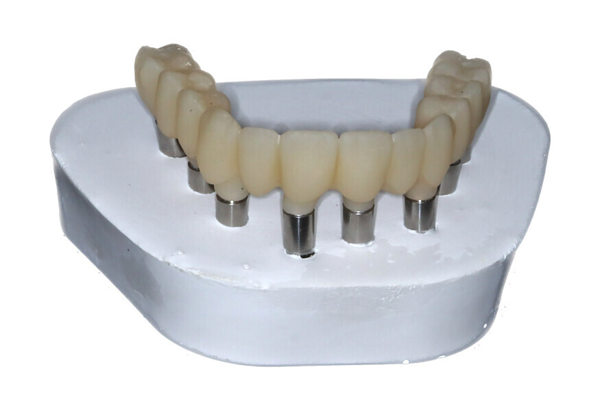 Fig. 15e: 3D-printed maxillary and mandibular restorations on verification casts.