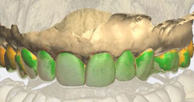 Elemento singolo in implantoprotesi in area estetica: proposta di protocollo clinico semplificato