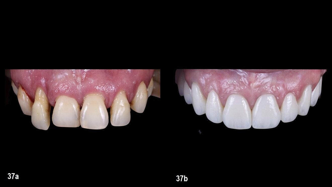 Figs. 37a & b: Intra-oral situation before (a) and after the treatment (b)