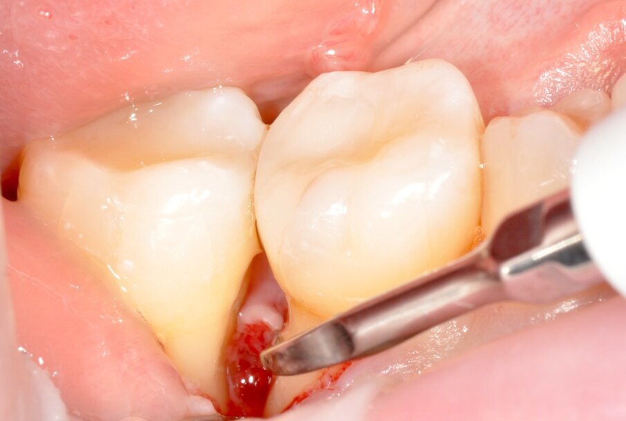 Fig. 10 - Debridement ultrasonico della radice distale dell’elemento 4.6.