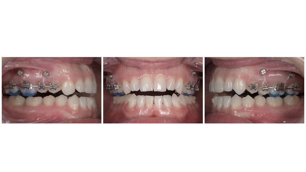 Figs. 44a–c: Transverse decompensation of the mandibular arch achieved with aligners.