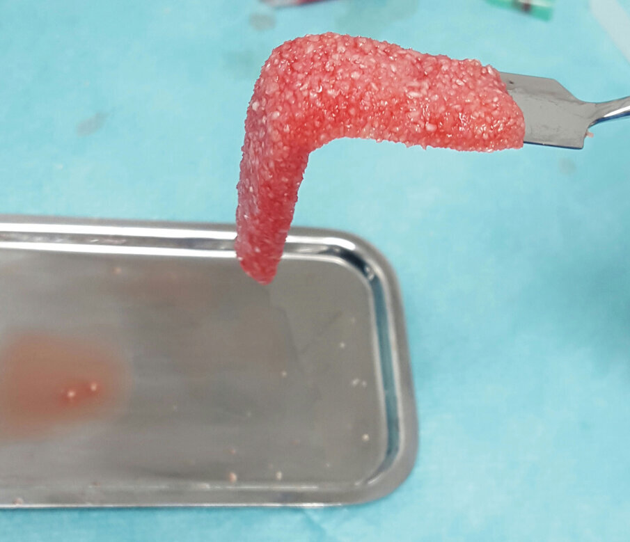 Fig. 6: PRF steaky bone.