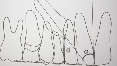 Trattamento intercettivo dell’inclusione del canino: perché aspettare?