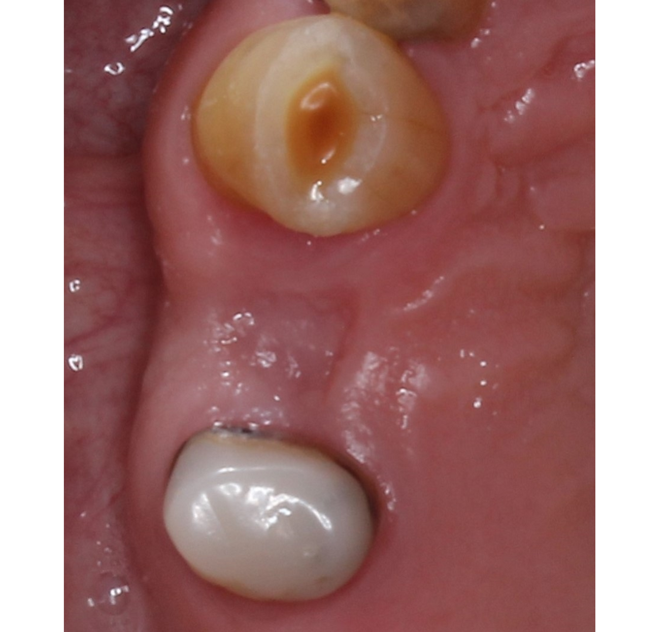 Fig. 4: Post-extraction site.