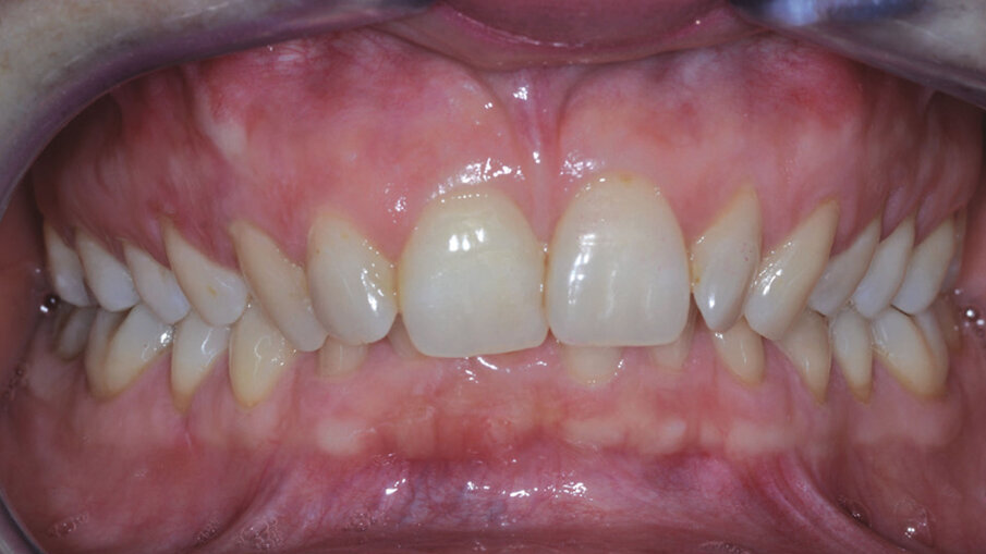 Figg. 4d-4f_Foto intraorali di inizio trattamento.