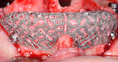 Ricostruzione tridimensionale di un’arcata superiore edentula