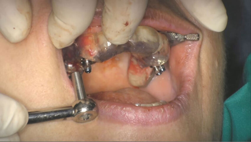 Figg. 48, 49_Inserimento impianto.