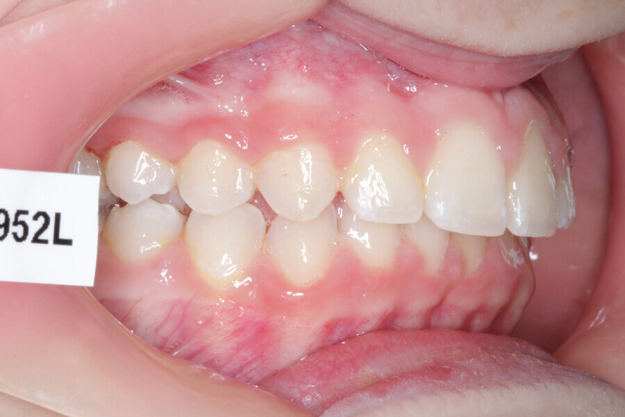 Fig. 6: Initial situation. Class II malocclusion patient.