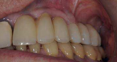 Soulevé de sinus et ostéotenseur : le Fractal lift