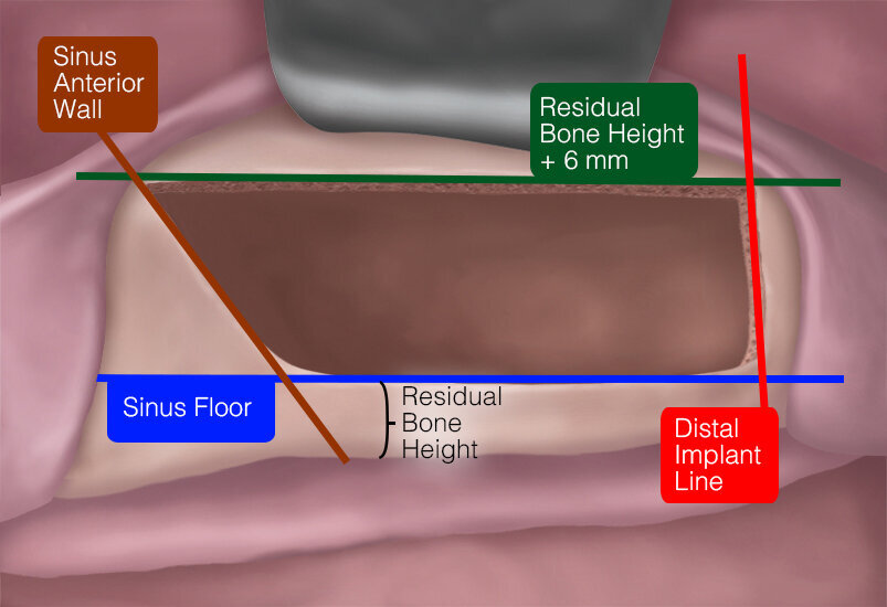 Fig. 1 - Il disegno dell’antrostomia nella tecnica Low Window. La linea osteotomica inferiore (blu) è a filo col pavimento del seno mascellare; quella superiore (verde) è posizionata più apicalmente di 6 mm, ovvero a una distanza dal margine crestale pari allo spessore della cresta aumentato di 6 mm. La linea mesiale (marrone) è a filo con la parete anteriore del seno. Quella distale (rossa) dovrebbe essere posizionata in corrispondenza dell’impianto più distale. 