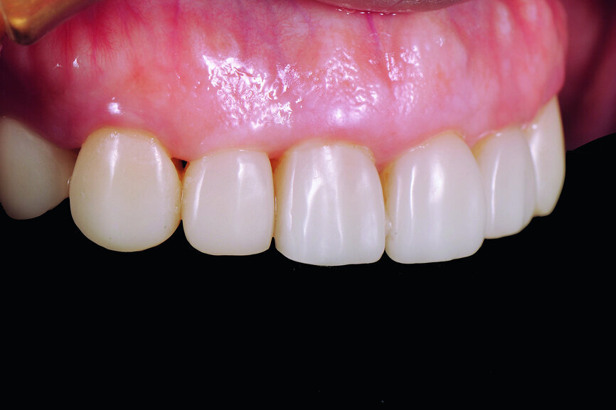 Fig. 27: Four-year follow-up: lateral view of upper-anterior dentition.
