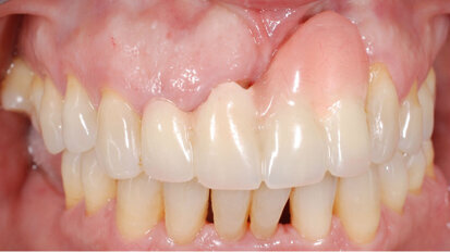 Gestione dei tessuti molli in un caso di malposizionamento implantare in area estetica