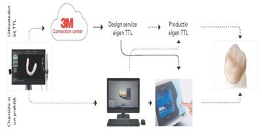 DITARE: nieuwe optie tussen vulling en kroon