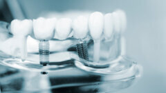 Researchers combine orthopaedic and dental expertise to improve implant longevity