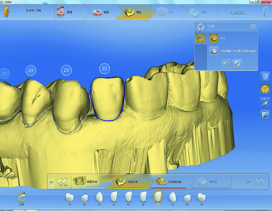 Fig. 16: Setting the insertion direction and margin of the restoration.