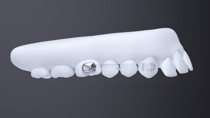 Solving sagittal discrepancies in orthodontics is probably the most energy-demanding movement you can do with aligners