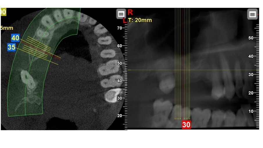 Fig. 2_CBCT dopo l’estrazione dell’elemento dentale 15.