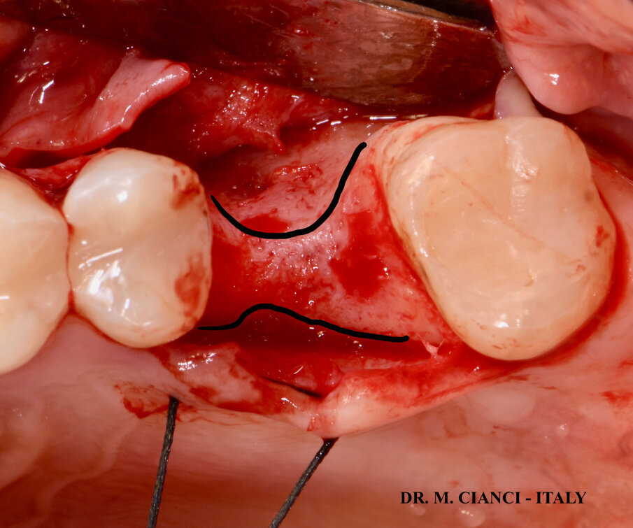 Fig. 1 - Atrofia tridimensionale cresta ossea.