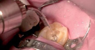 Zastosowanie laserów w stomatologii dziecięcej