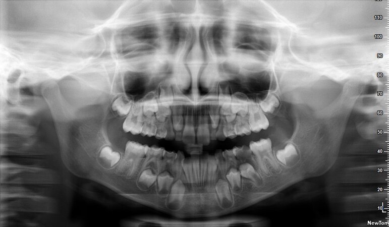 Fig. 12_Ortopantomografia iniziale.