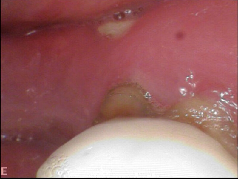 Figs. 12a–d: Sequestra of necrotic bone that had become loose and were removed from the exposed area.