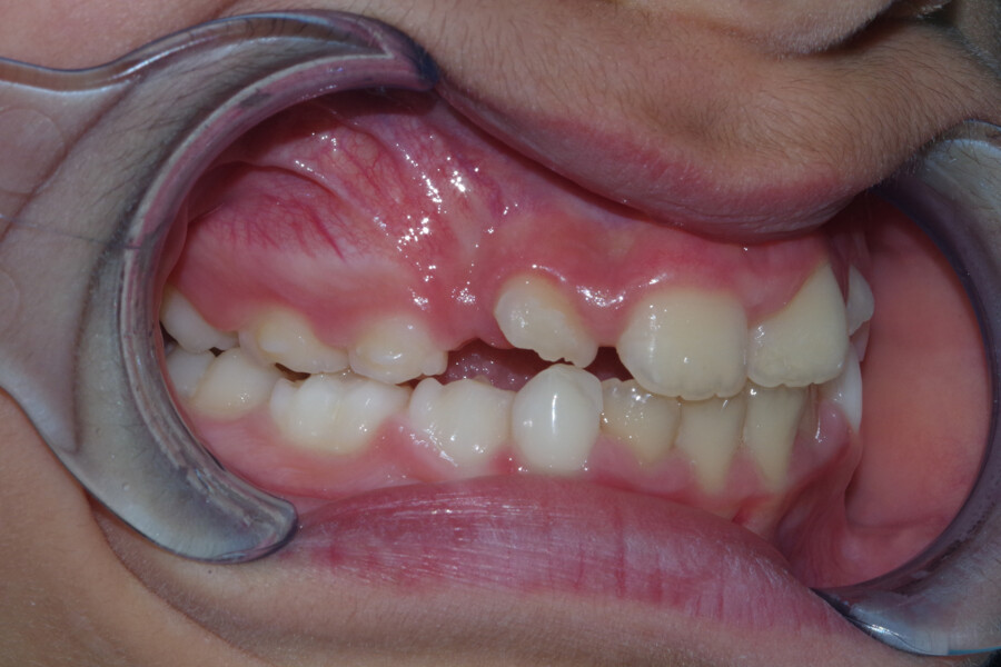 Fig. 10a: Intra-oral photographs at the 24-month follow-up: right lateral view.