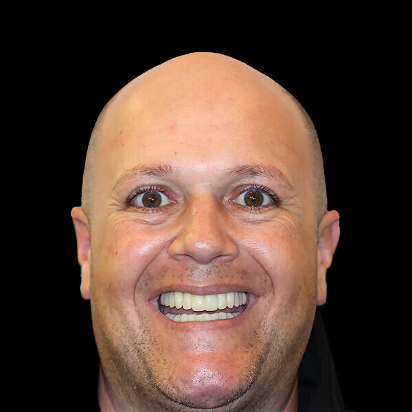 Fig. 14c: Retracted view of the provisional restorations (a) fabricated with C2F small hole technology (b). Two-week post-op smile (c). Two-week post-op panoramic radiograph and intra-oral photograph showing excellent healing (d & e).