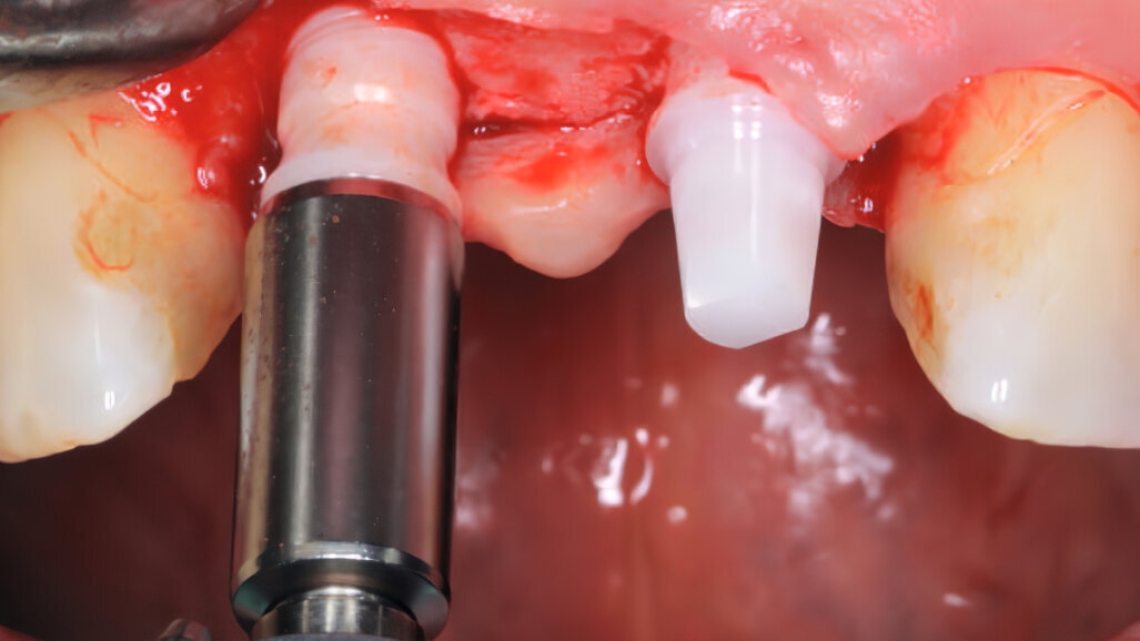 Bredent implant awarded quality mark at EAO congress