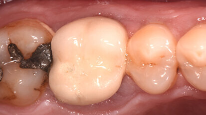 Restauración de una pieza tratada con endodoncia