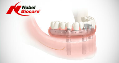 Nobel Biocare demonstrates revolutionary full-arch solution