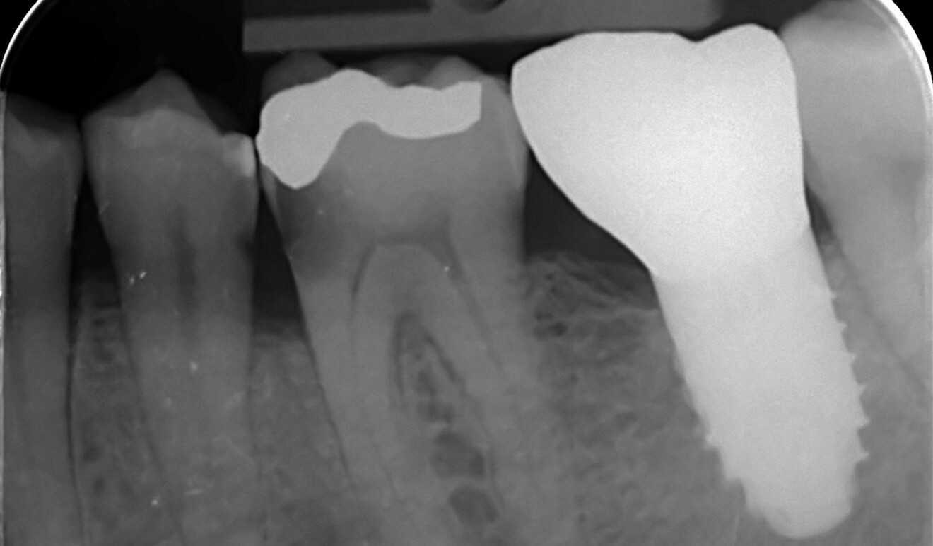Fig. 14b: Pre-op radiographic views of tooth #36 showing the old amalgam restoration and the extent of the carious lesion.