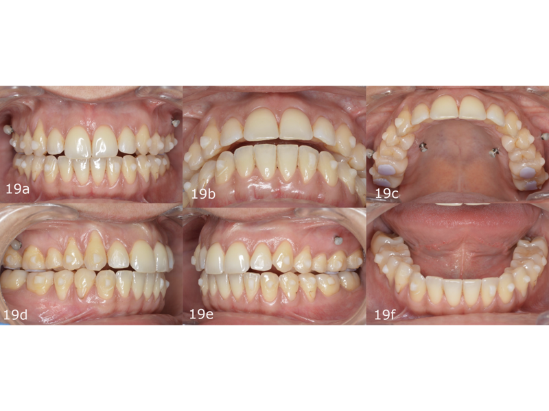 Figs. 19a–f: Situation after seven months of treatment.