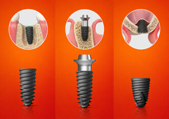 Osstem Implant – New KS implant line