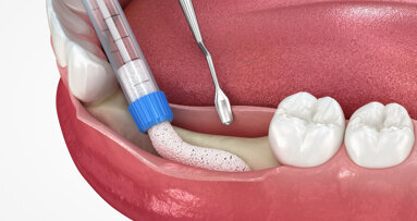Webinar to focus on peri-implant tissue augmentation and maintenance