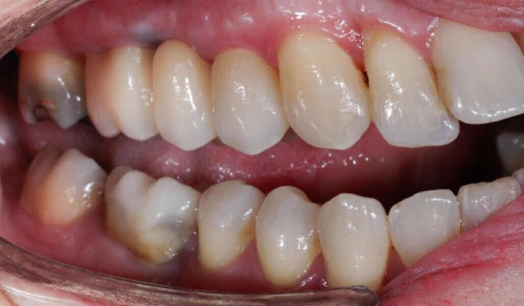 Fig. 11: Bridge on teeth #14–16 in place. 