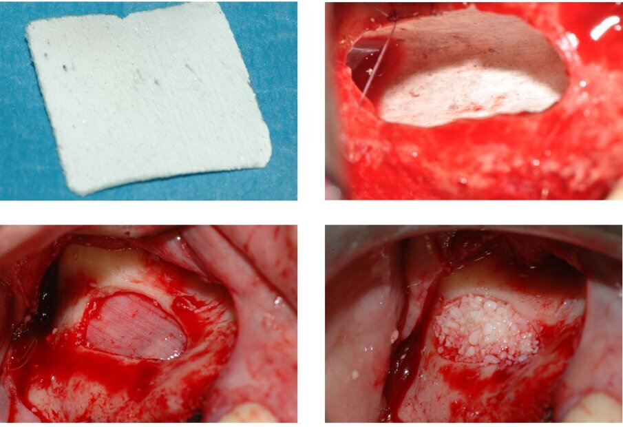 Fig. 9_La stessa operazione può essere compiuta utilizzando una membrana corticale equina (in alto a sinistra) non dissimile dalla lamina mostrata in figura 8, ma di spessore inferiore (0,2 mm): la lamina è posizionata al di sotto della membrana sinusale sfruttandone l’elasticità (in alto a destra). Nel caso mostrato, dopo avere completato il riempimento della cavità (figura in basso a destra), una seconda membrana corticale, identica alla prima, è imbustata al di sotto dei margini dell’antrostomia a chiusura della cavità. Successivamente è stata posizionata una membrana di collagene a copertura vestibolare.dell’antrostomia a chiusura della cavità (figura in basso a destra). In questo caso, non è stata posizionata una membrana di collagene a copertura vestibolare. 