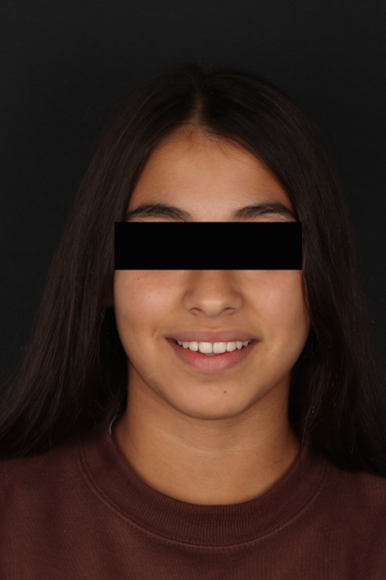 Fig. 27: Extra-oral clinical photograph showing the patient’s smile during treatment.